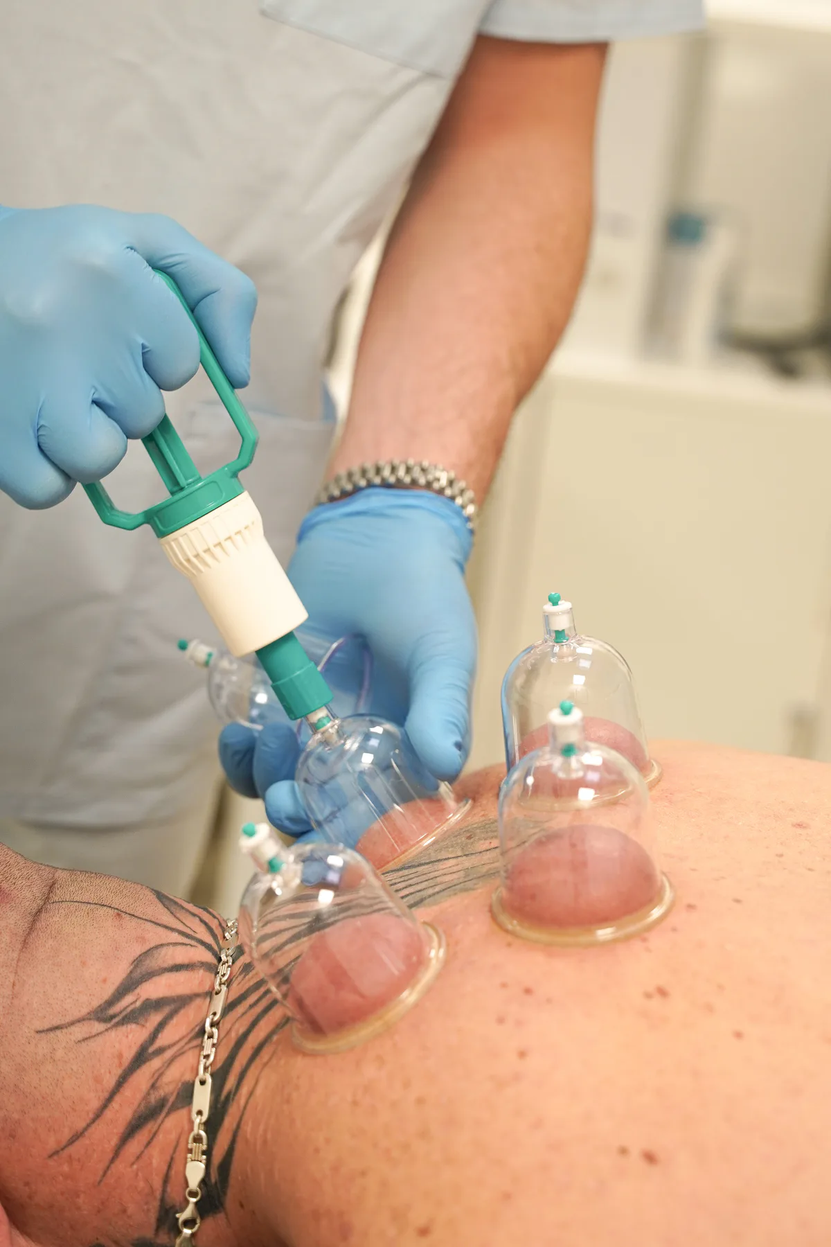 Schröpfgläser während einer Behandlung bei Melimedics